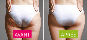 Chassez votre cellulite